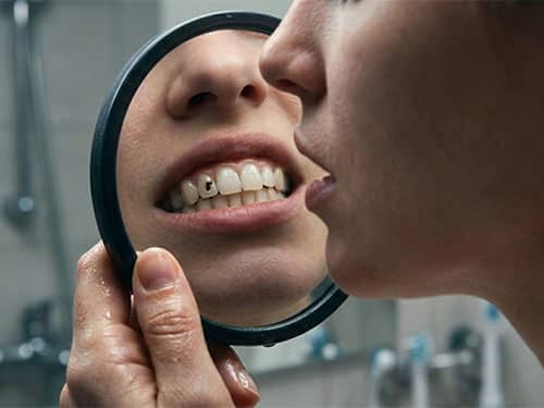 Кариес на передних зубах