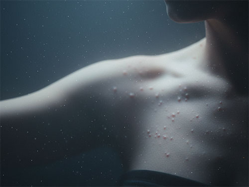 Сыпь на теле