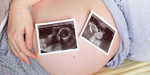 беременность двойней