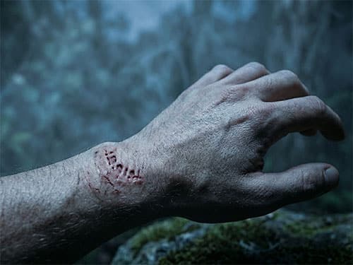 Укус на руке